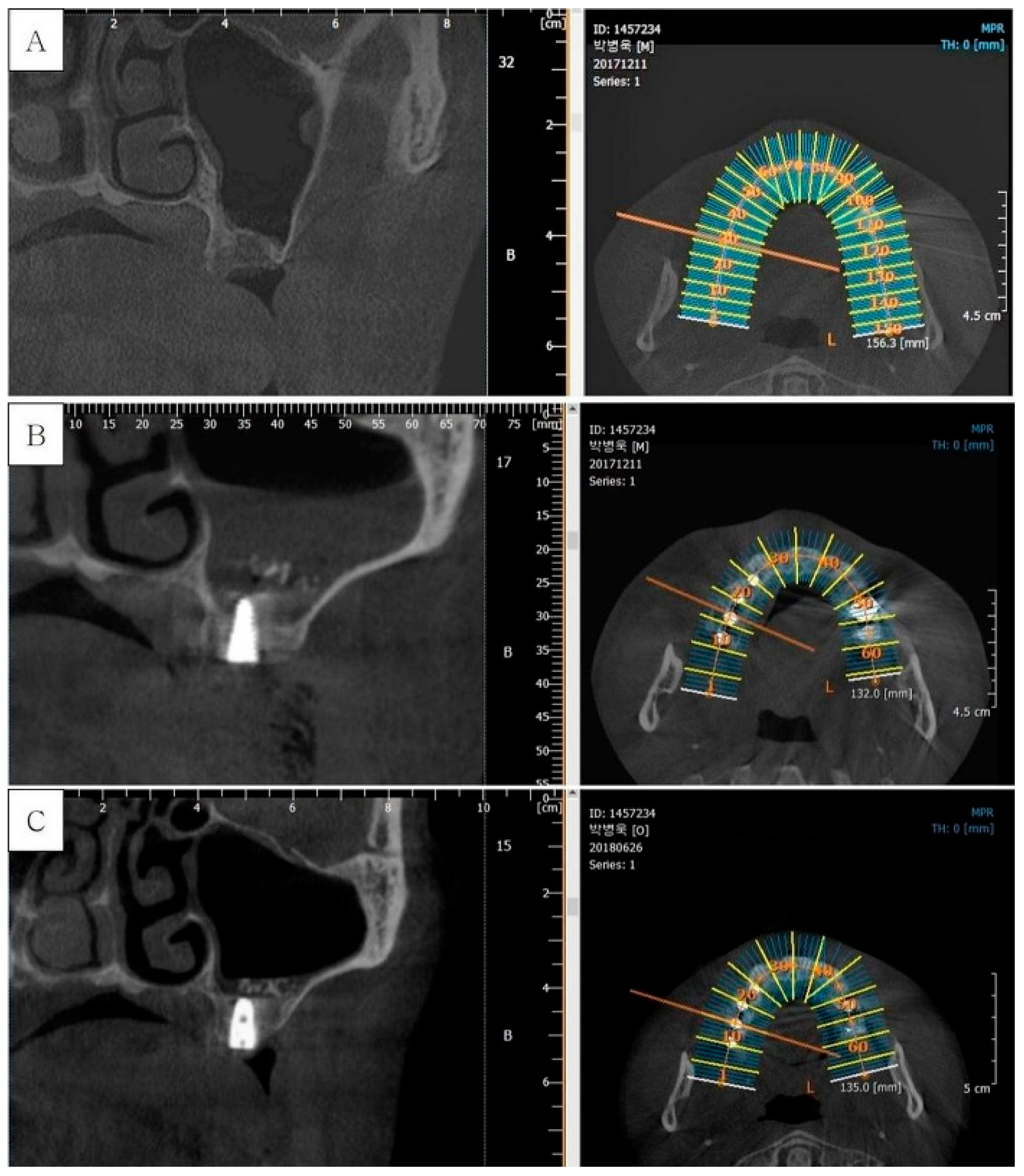 Figure 2: Cone-beam computed tomography of subject number 4: (A) Pre-operative CBCT of #16 area. (B) Post-operative CBCT of #16i. (C) CBCT on re-entry surgery of #16i.